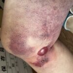 ブルネイ① 怪我をした22日からの怪我記録